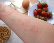 Atlanta food allergy treatments for hives.