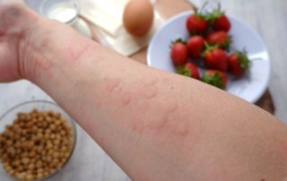 Atlanta food allergy treatments for hives.