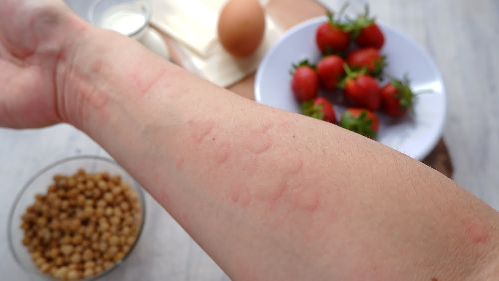 Atlanta food allergy treatments for hives.