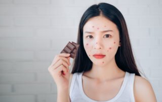 Atlanta chocolate allergy treatment