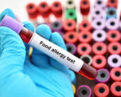 Atlanta blood testing for food allergies.
