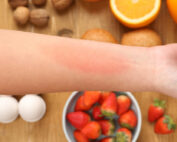 Atlanta food allergy treatment plan.