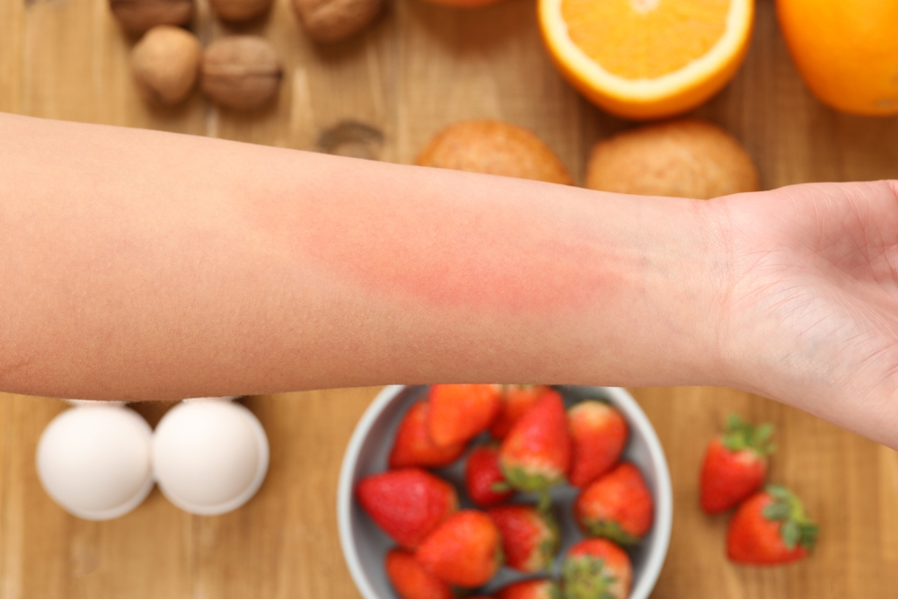Atlanta food allergy treatment plan.